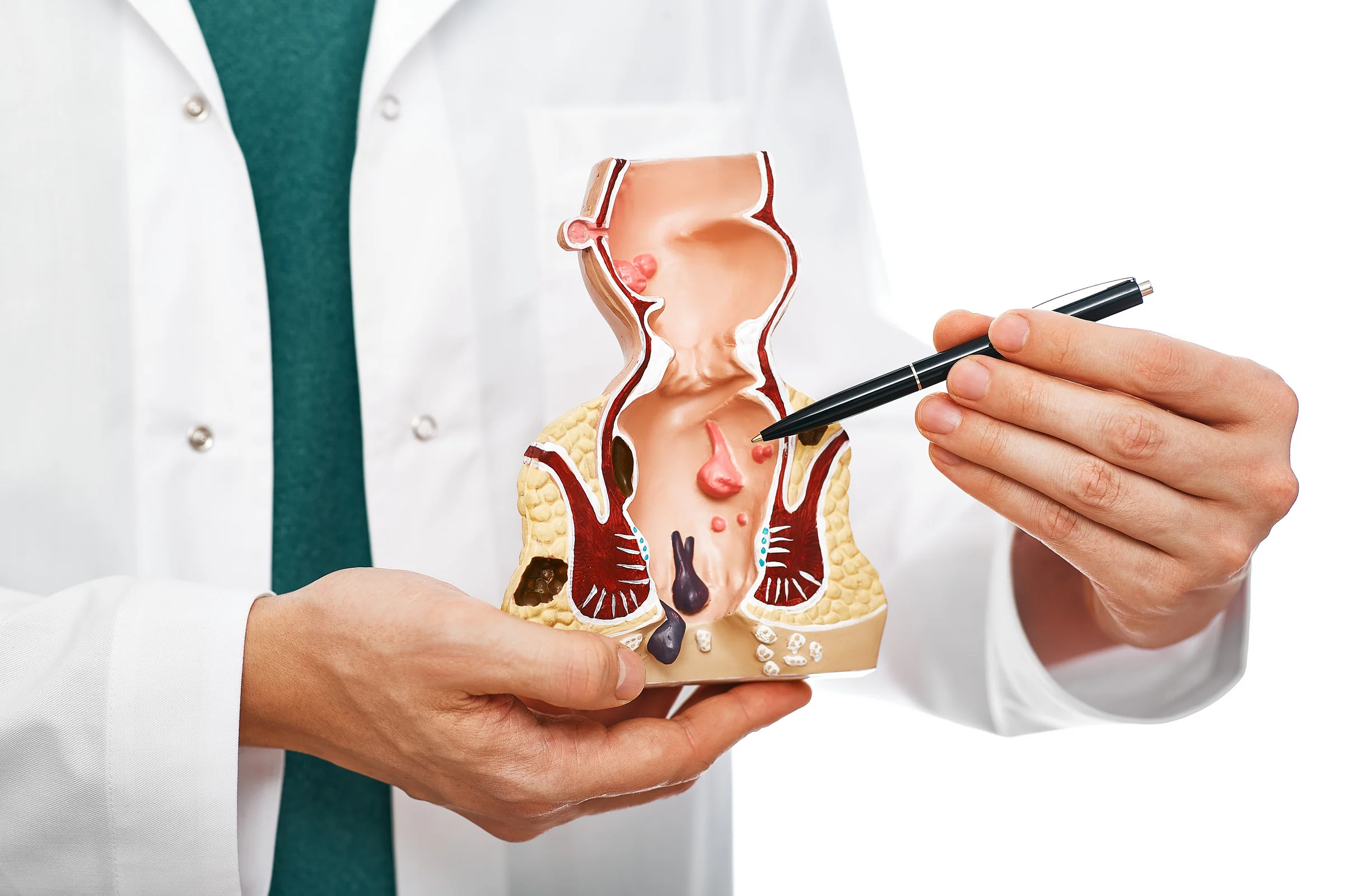 Ulcerative Colitis Hemorrhoid Relief During Bowel Movements