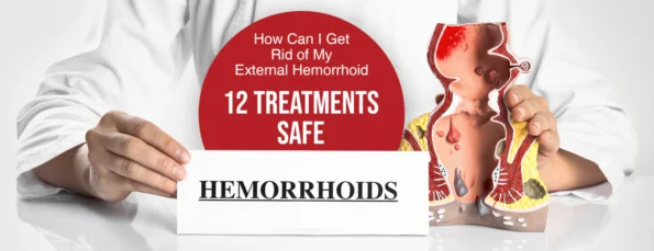 Getting Rid Of External Hemorrhoids
