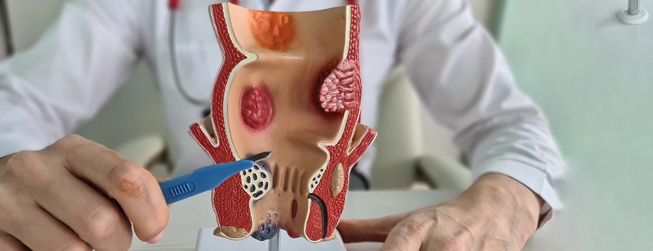 Treatment for external hemorrhoids that don't bleed