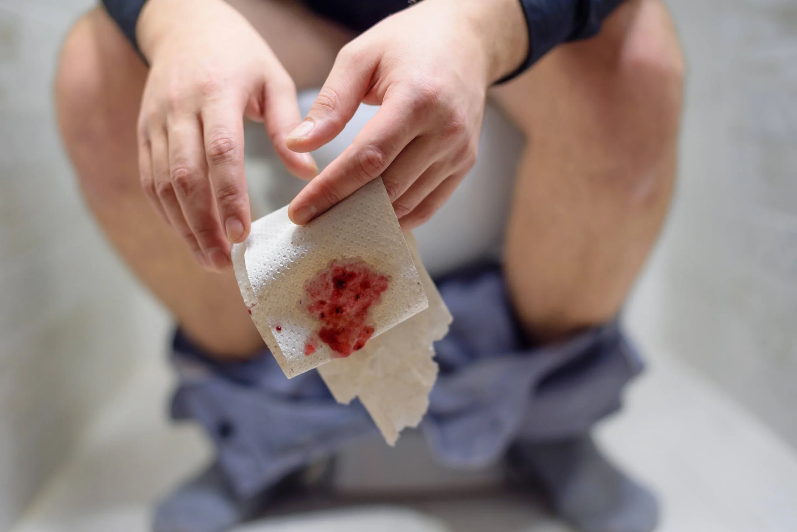 Treatment for Thrombosed External Hemorrhoids by Lancing Bleeding