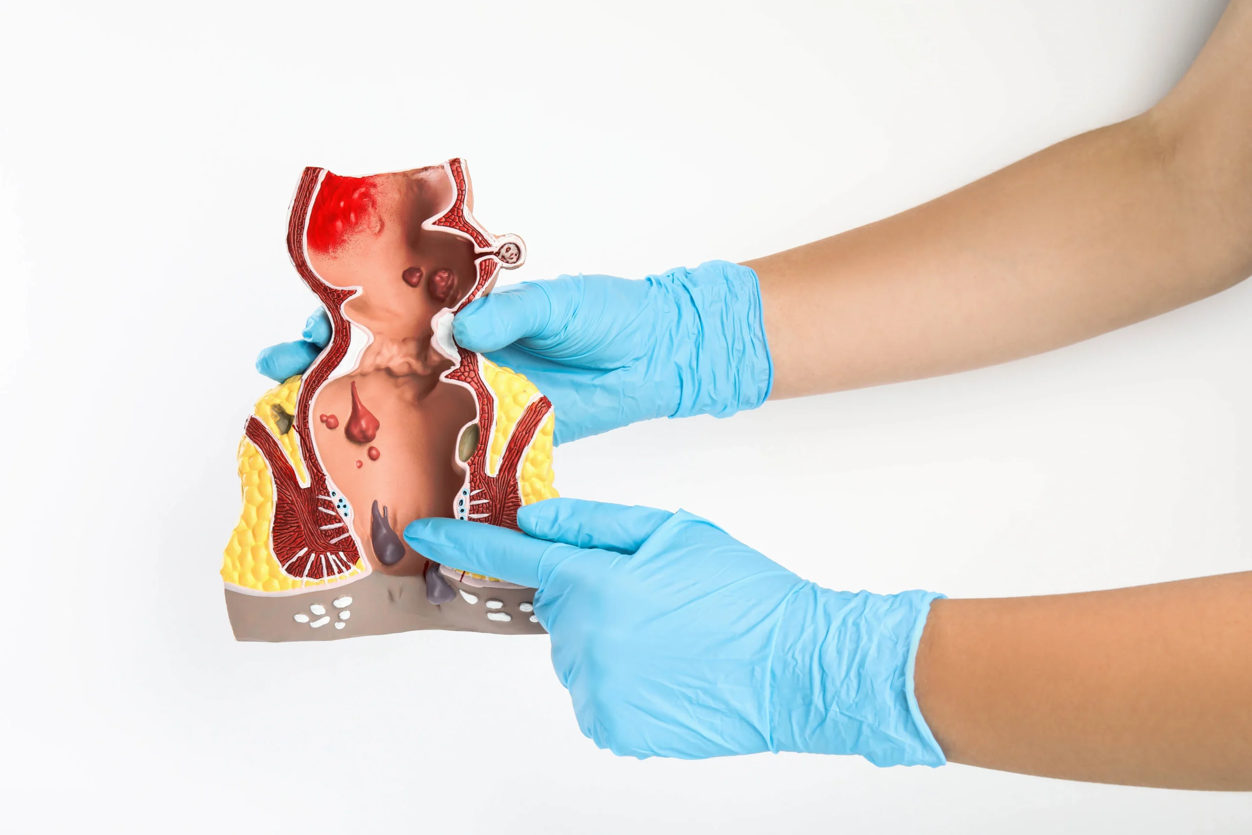 Grade of Internal Hemorrhoids Get an idea of how much they hurt