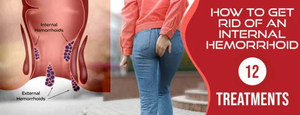 The best way to get rid of an internal hemorrhoid is to follow these steps