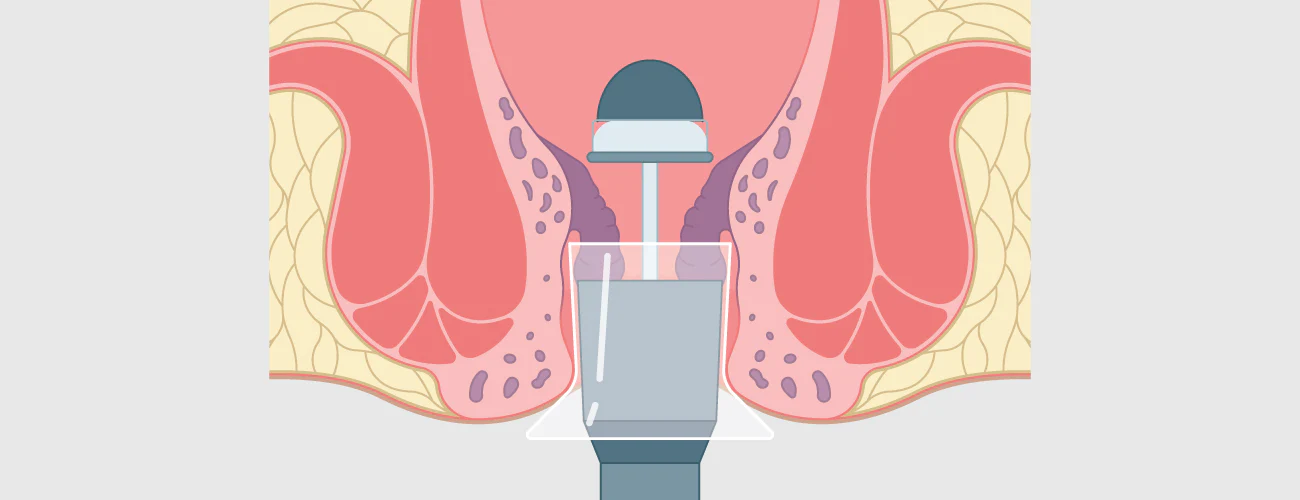 Getting rid of an internal hemorrhoid is easy with hemorrhoid stapling.