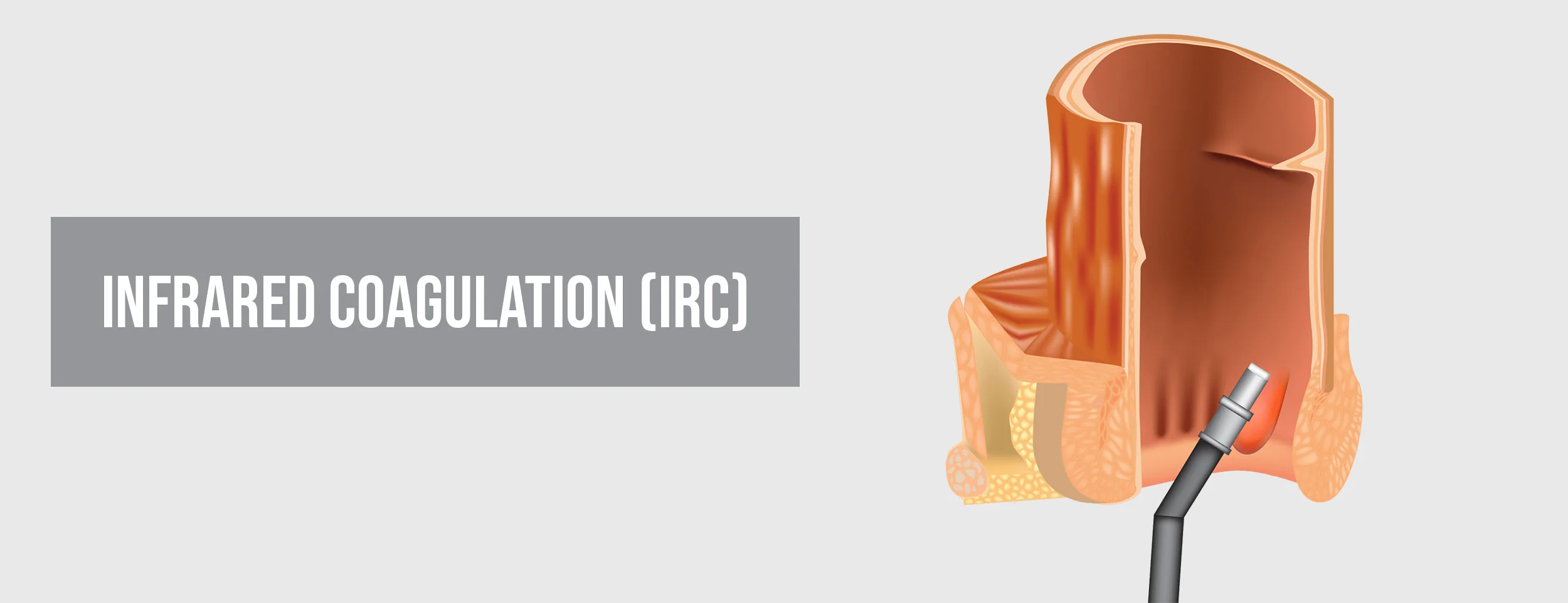 Coagulation or cauterization is the first step in getting rid of internal hemorrhoids