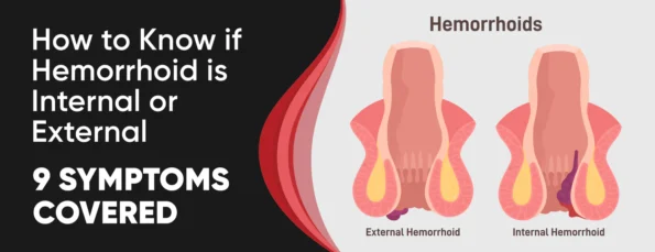 The Difference Between Internal and External Hemorrhoids