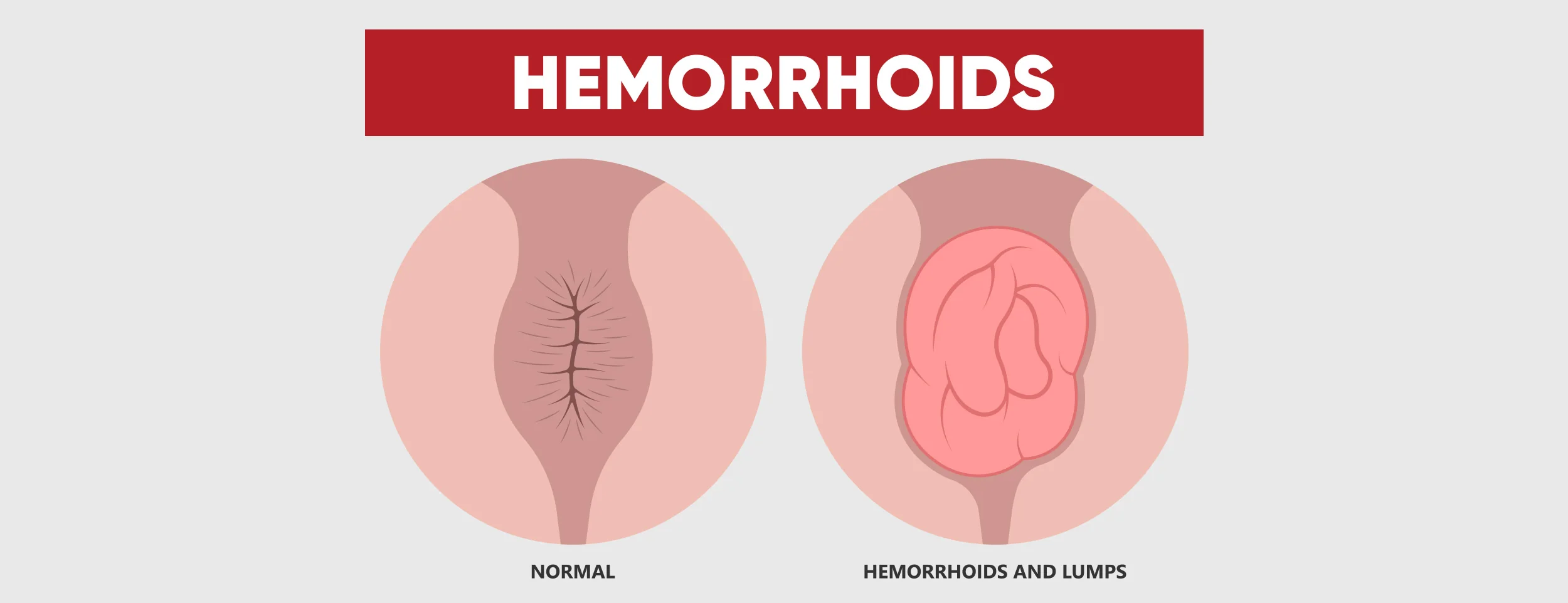 An External hemorrhoid infected with a hole
