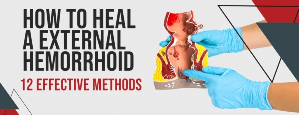 A Guide To Healing An External Hemorrhoid