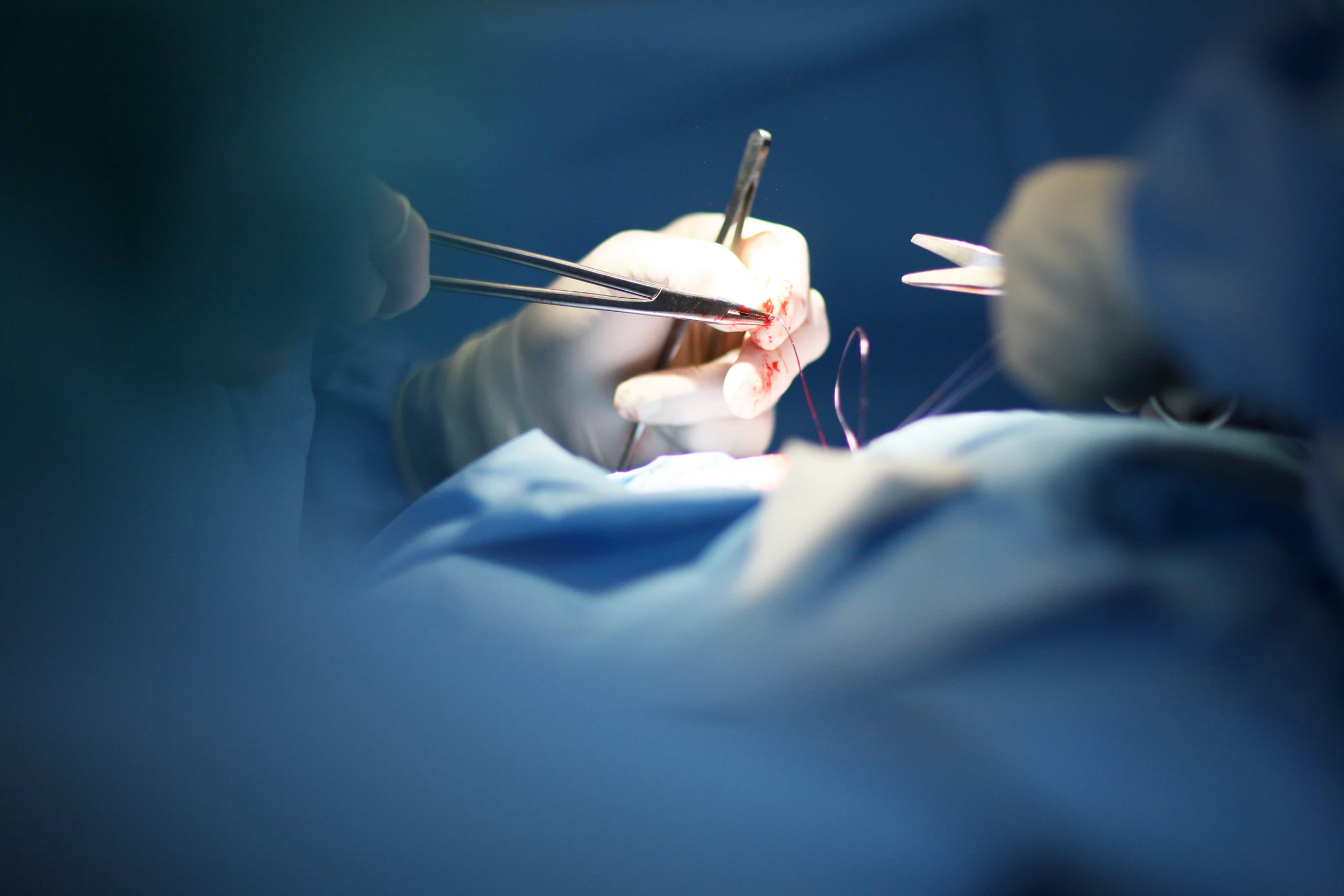 The removal of internal hemorrhoids can be painful