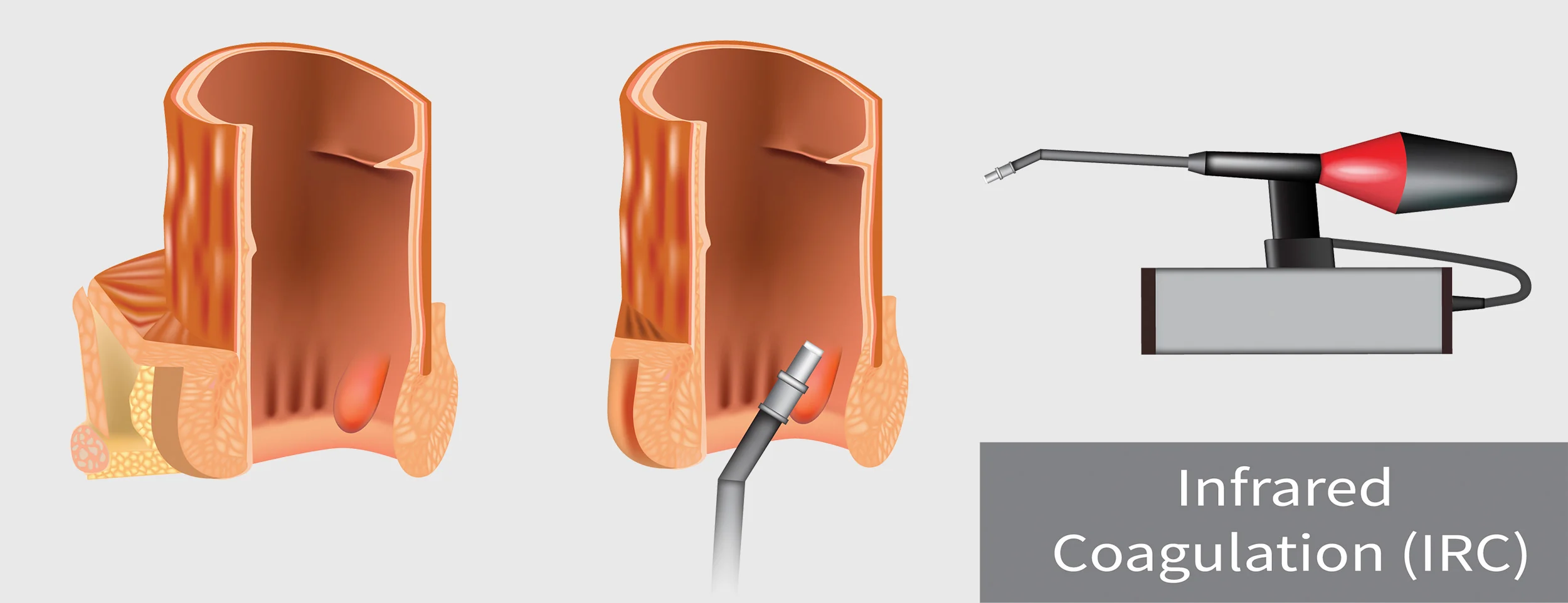 Hemorrhoids are surgically removed by coagulation therapy