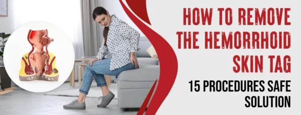 15 Procedures and causes for Removing Hemorrhoid Skin Tags