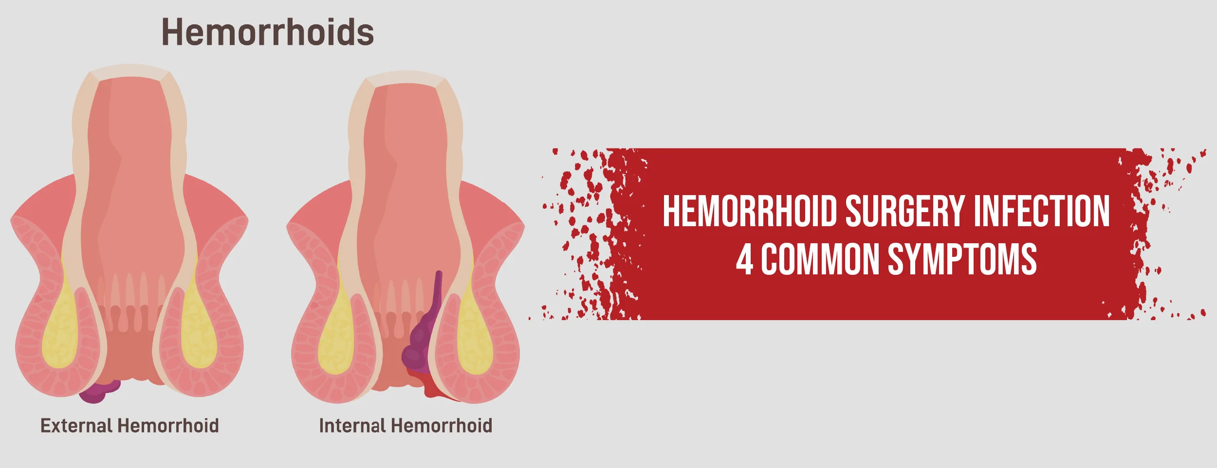 4 Common Symptoms of a Hemorrhoid Surgery Infection