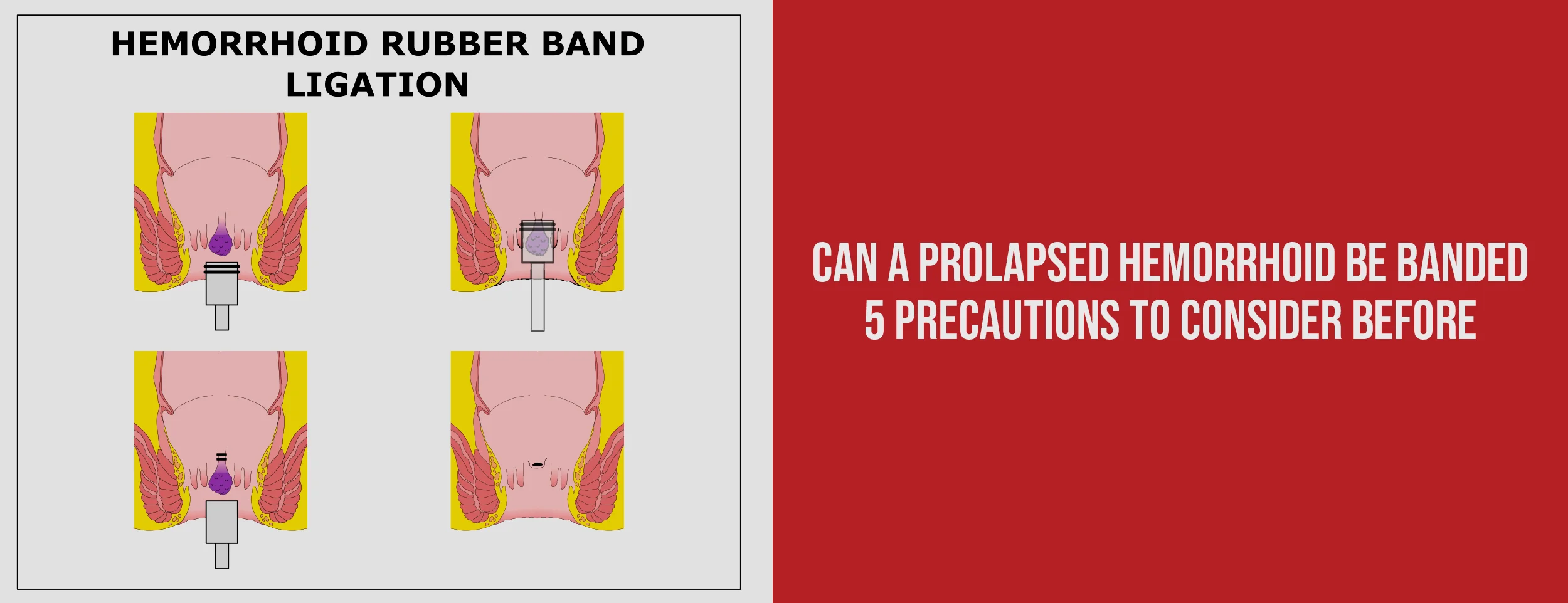 5 Precautions Before Banding a Prolapsed Hemorrhoid