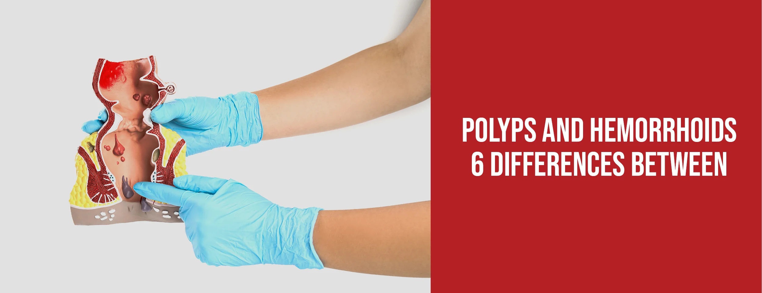 6 Differences Between Polyps and Hemorrhoids