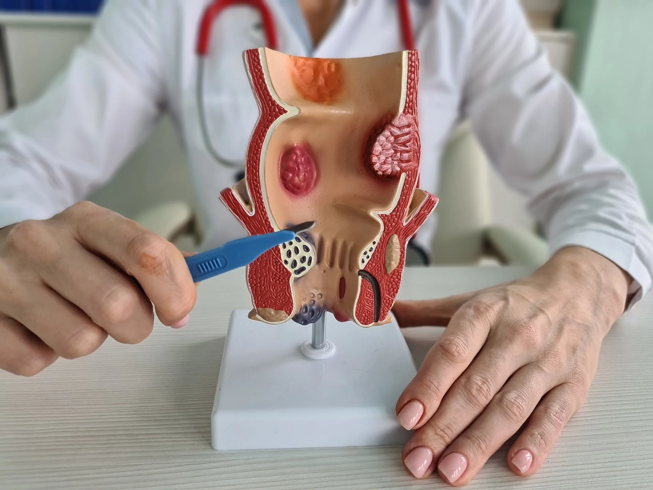 A Complete Guide to Removing Hemorrhoids