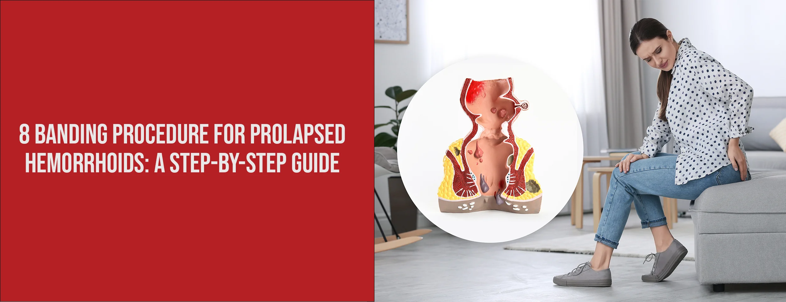 A Step-by-Step Guide to Banding Prolapsed Hemorrhoids