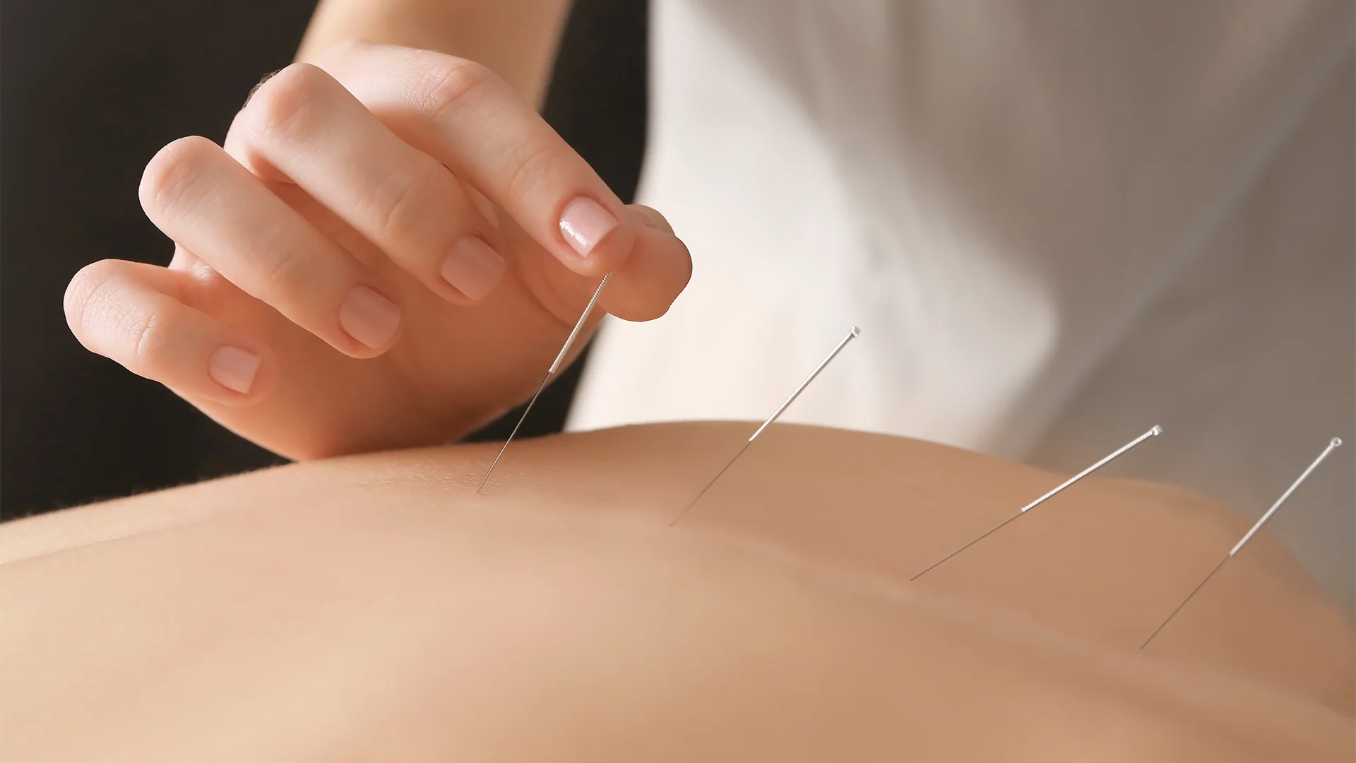 Acupuncture Side Effects for Hemorrhoids