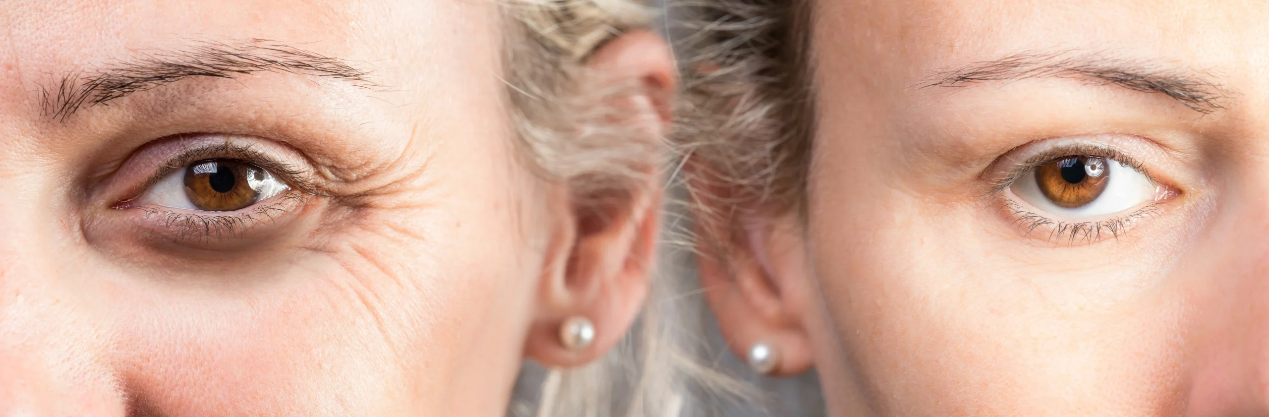 Benefits of Botox after chemical peels