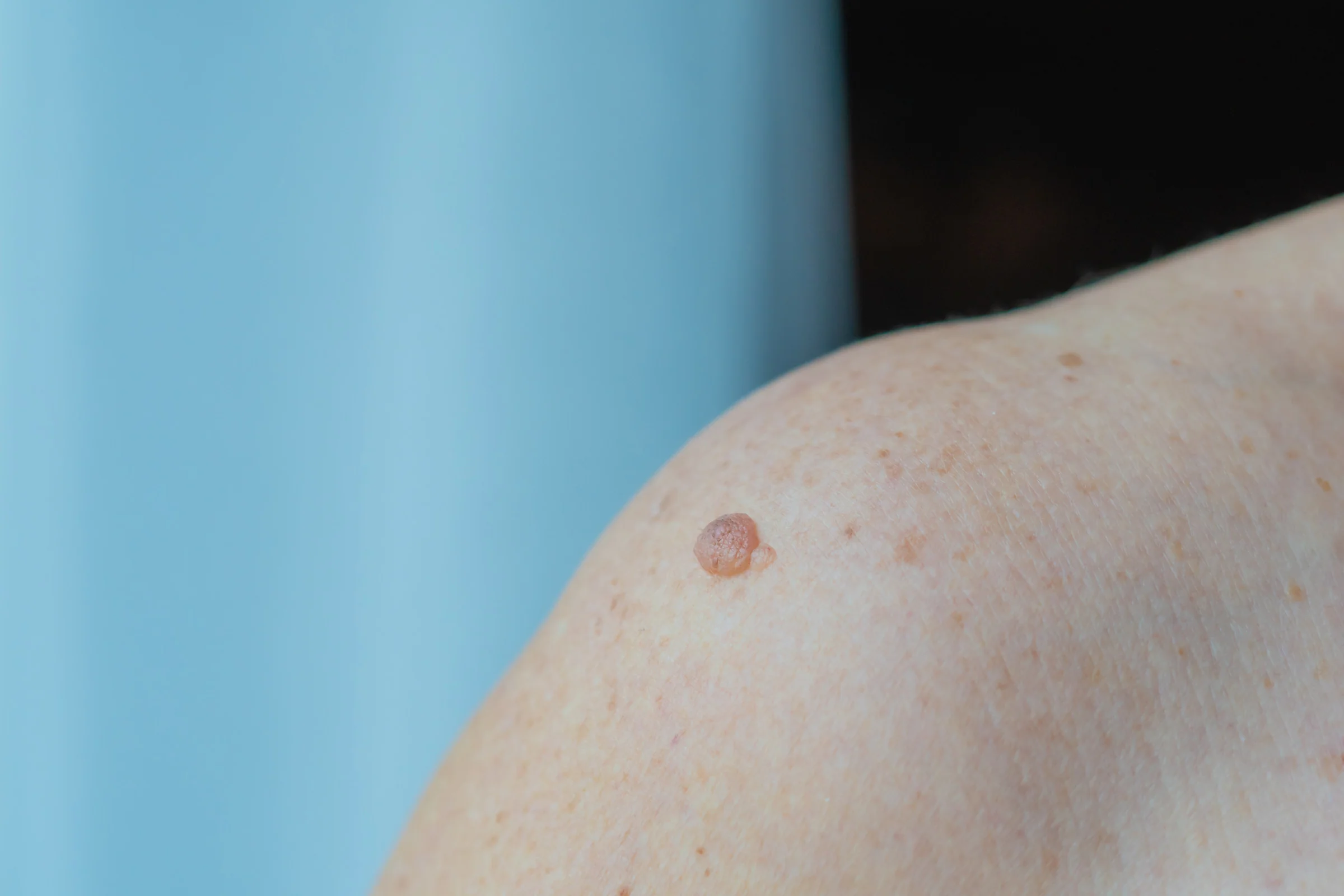 Comparison of Hemorrhoids and Skin Tags Prevention