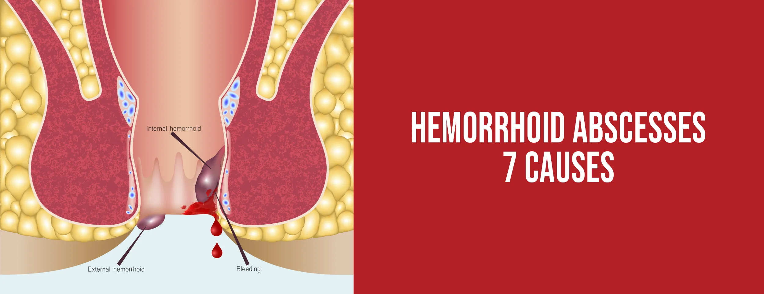 7 Causes Of Hemorrhoid Abscesses