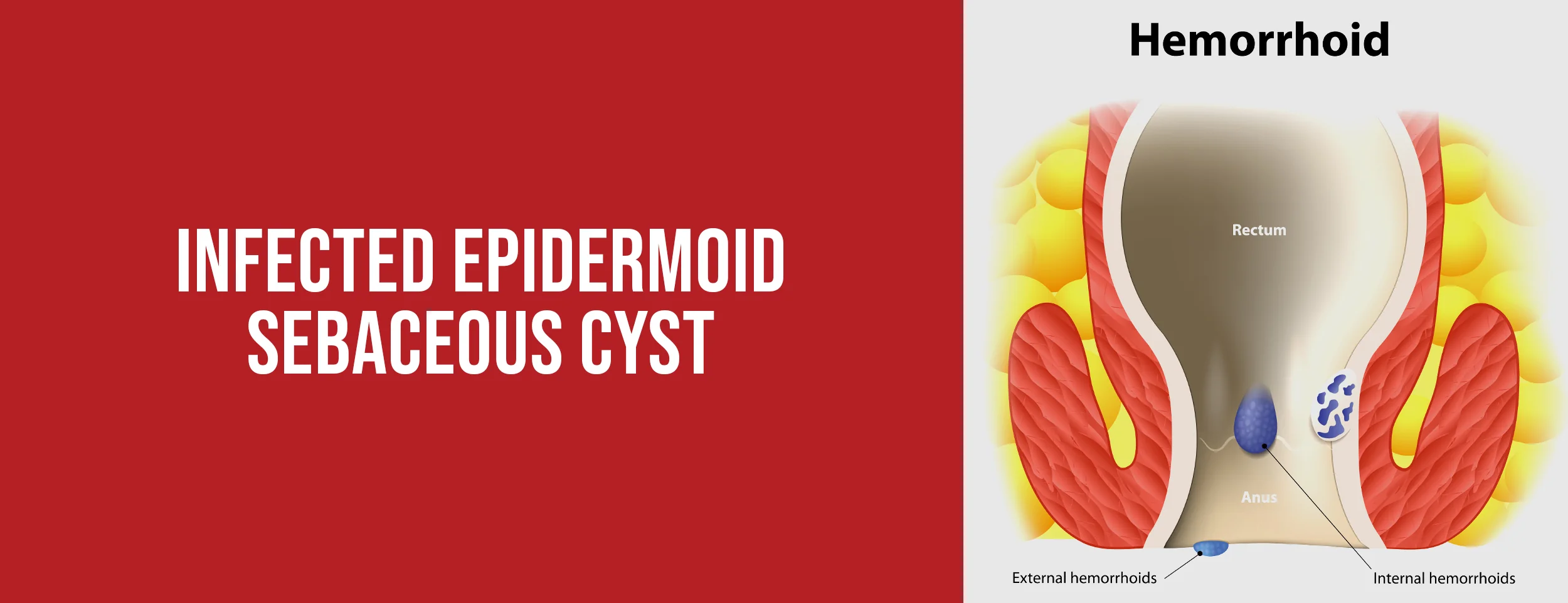 Infected Epidermoid (Sebaceous) Cyst