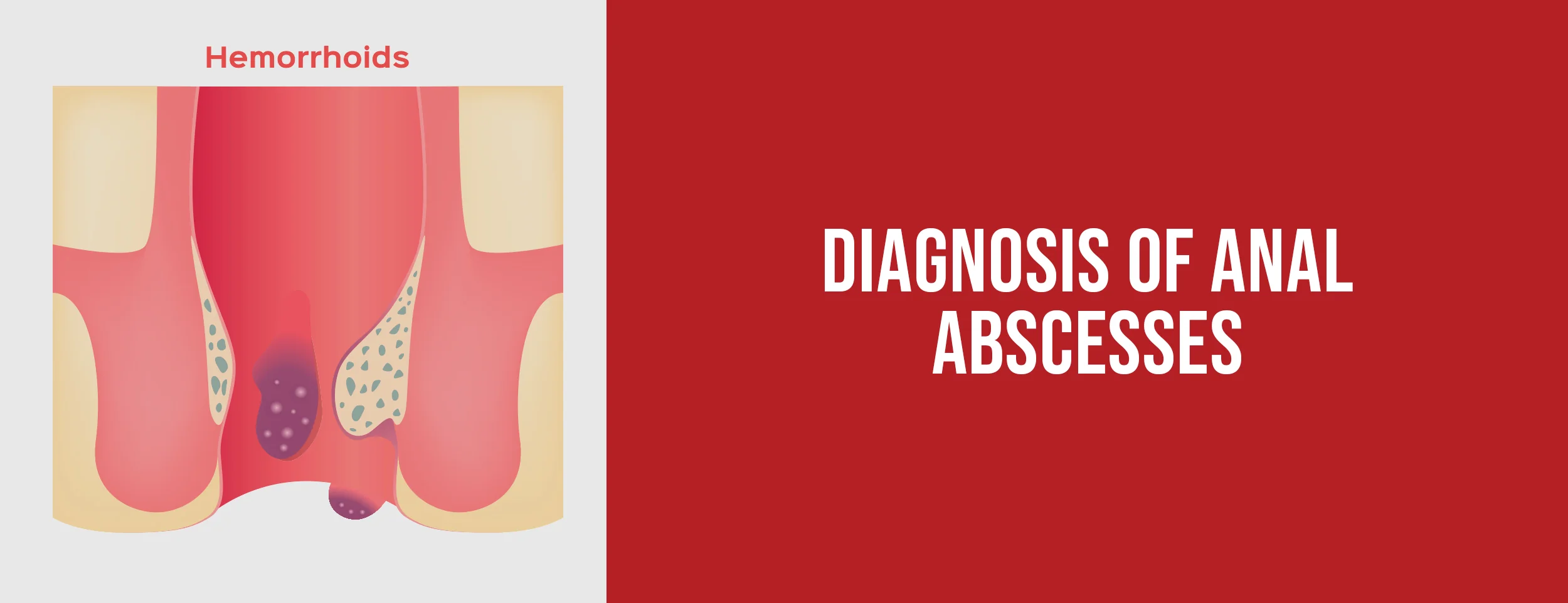 Diagnosis of Anal Abscesses