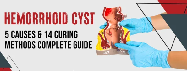 Causes and cures of hemorrhoids