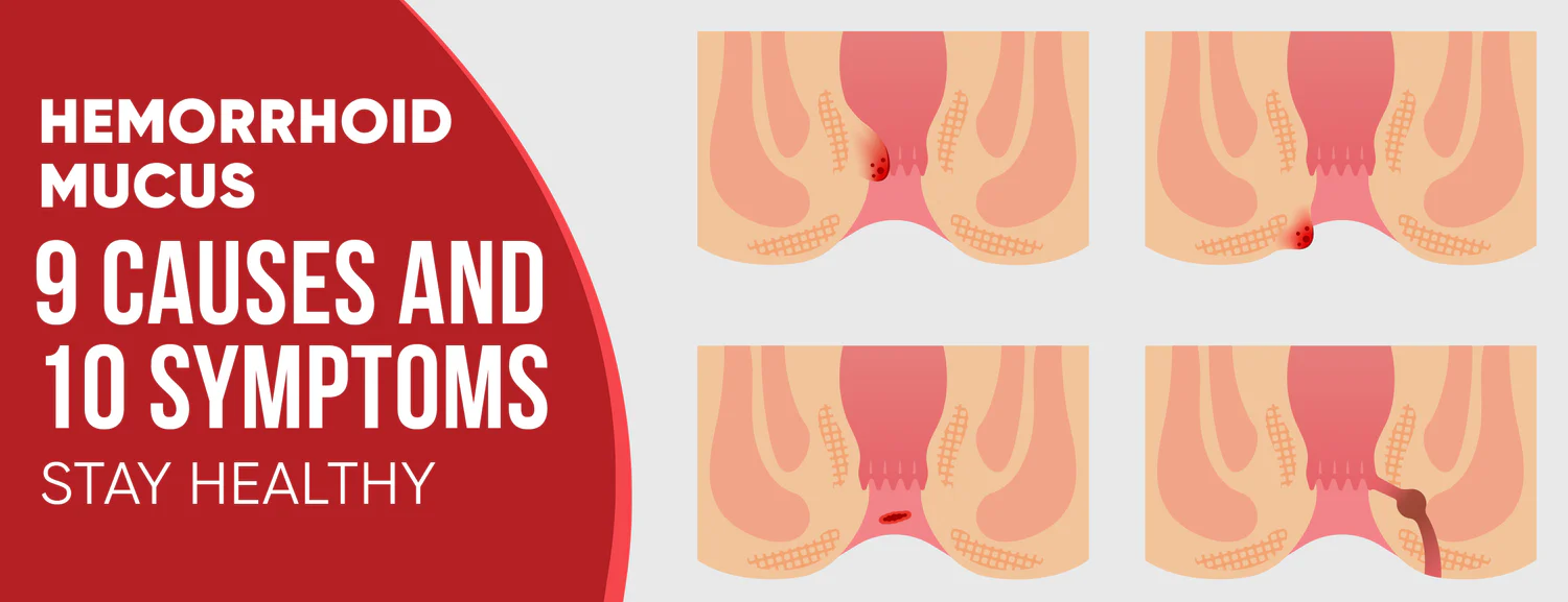 A hemorrhoid mucus is a sign of hemorrhoids