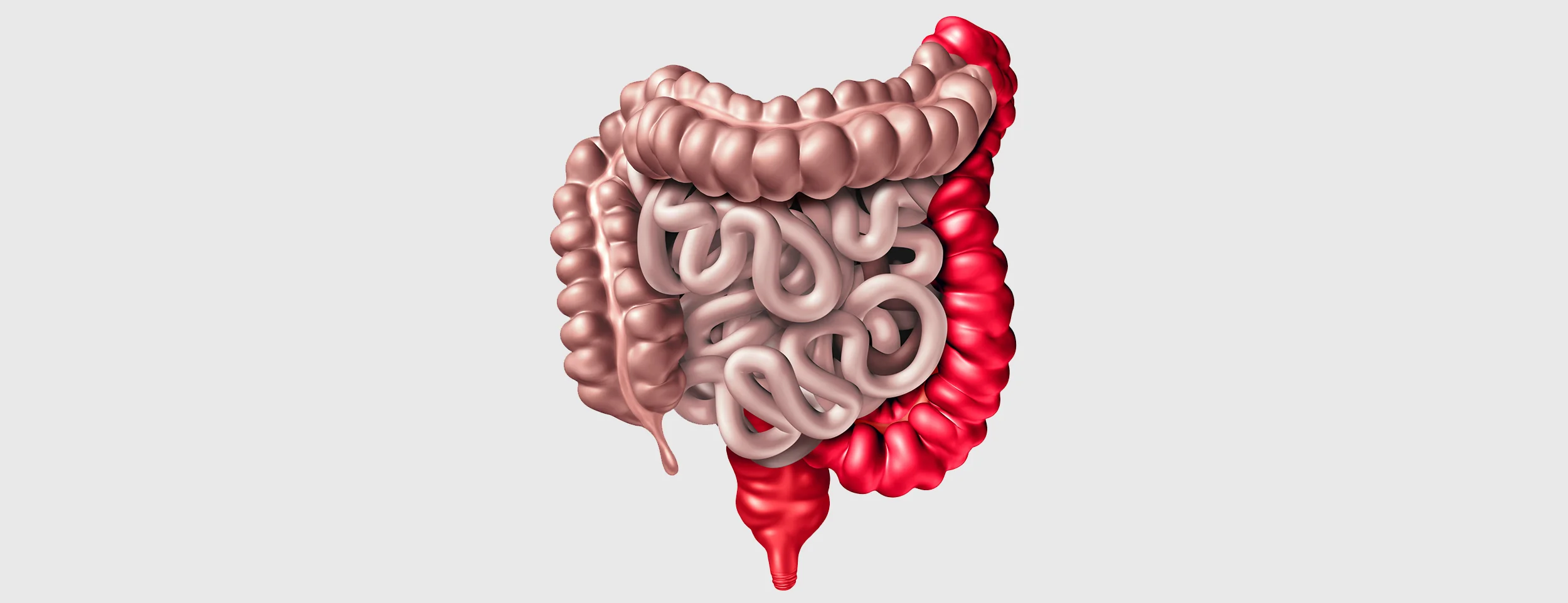 A hemorrhoid with mucus Ulcerative colitis