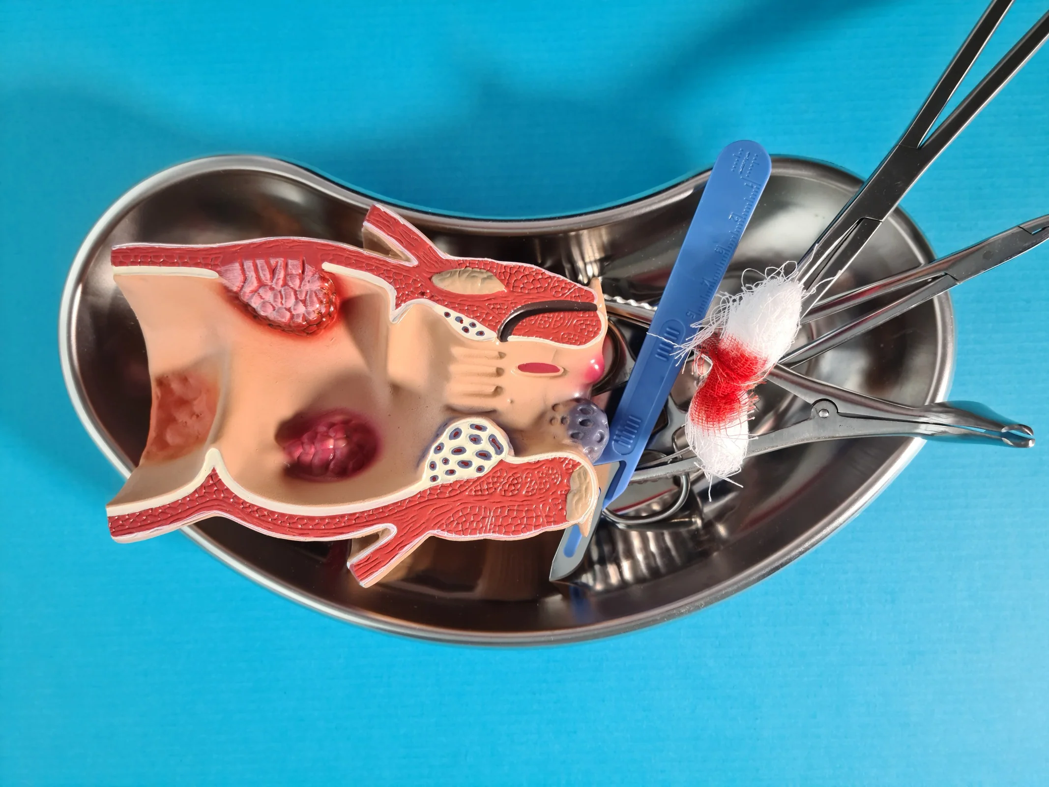 Hemorrhoids During and After Surgery with Different Anesthesia Techniques and Incision Techniques