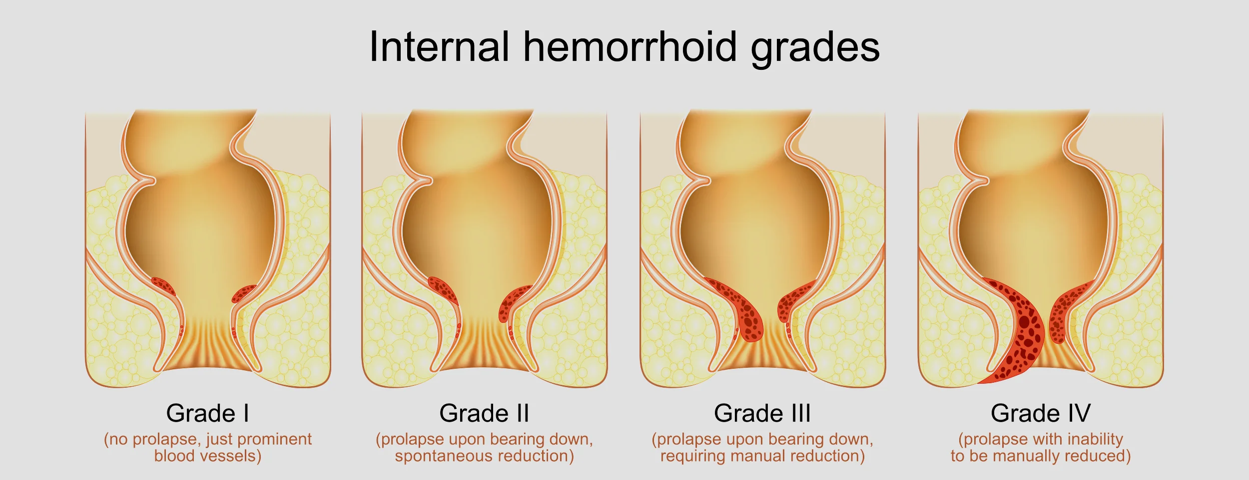 Hemorrhoids that have prolapsed: 9 symptoms