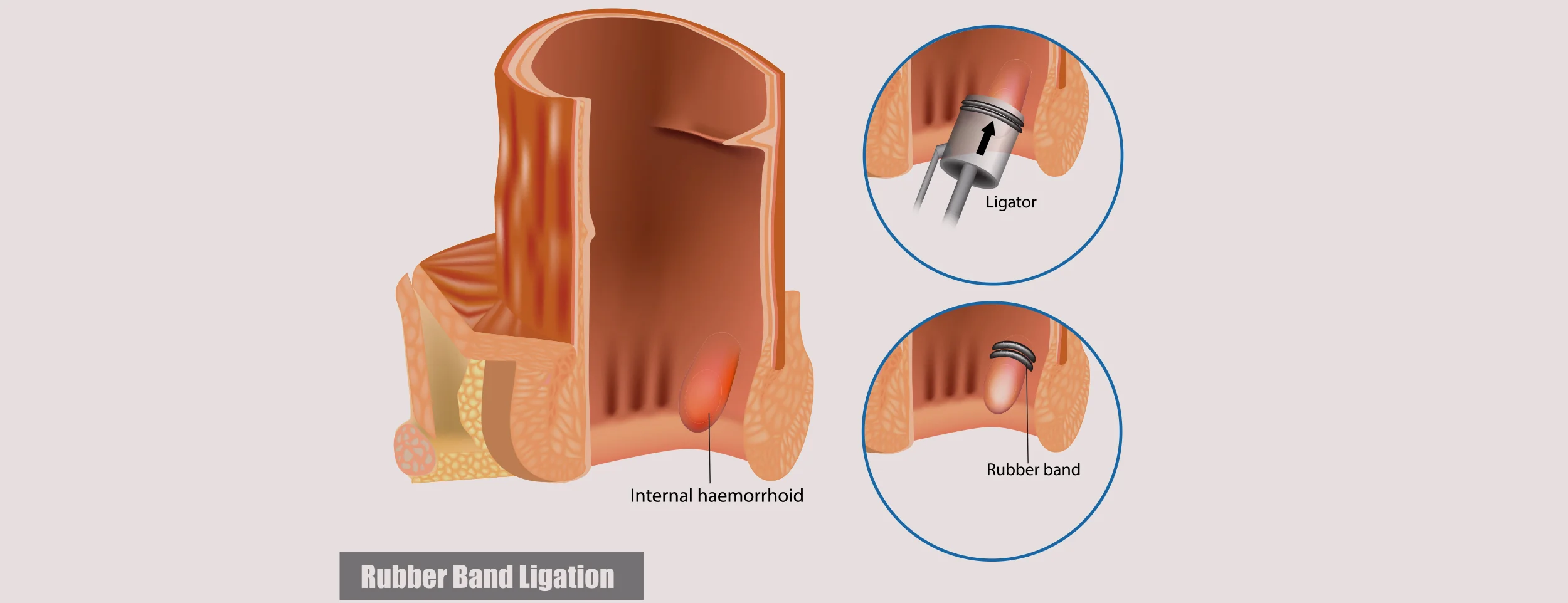 Hemorrhoids thrombosed by medical procedures Rubber Band Ligation