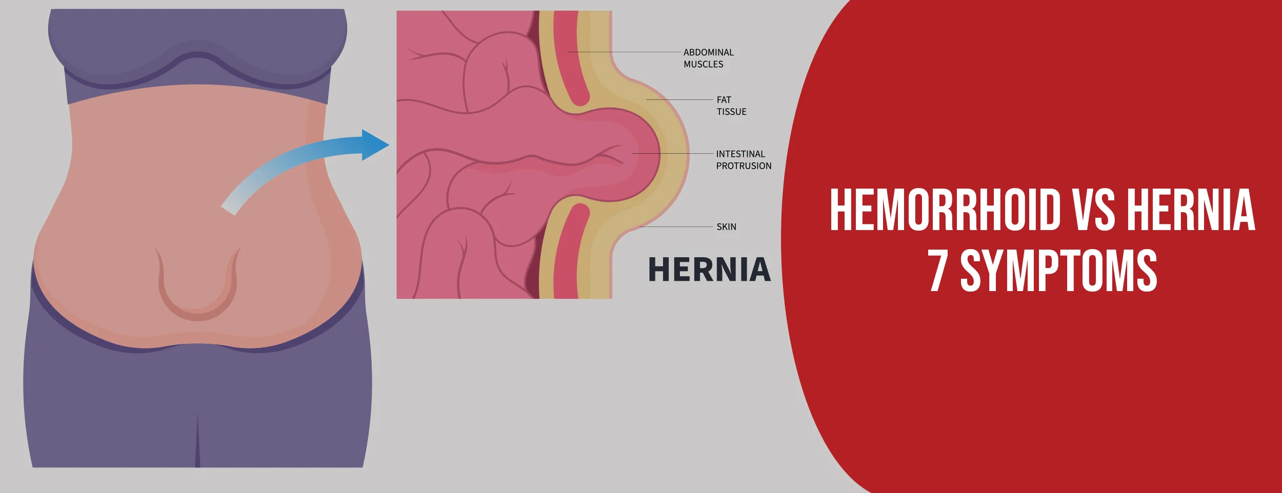 Symptoms of hemorrhoids vs hernias