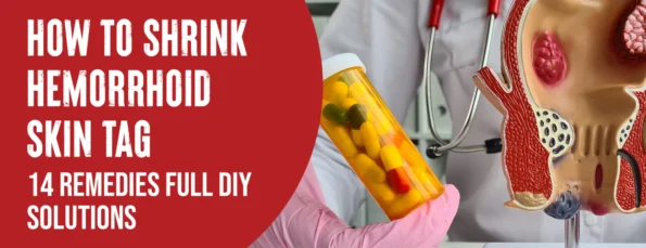 The 14 Best Ways To Reduce Hemorrhoid Skin Tags