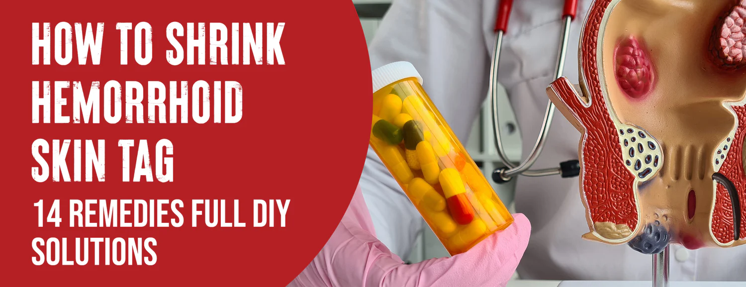 The 14 Best Ways To Reduce Hemorrhoid Skin Tags