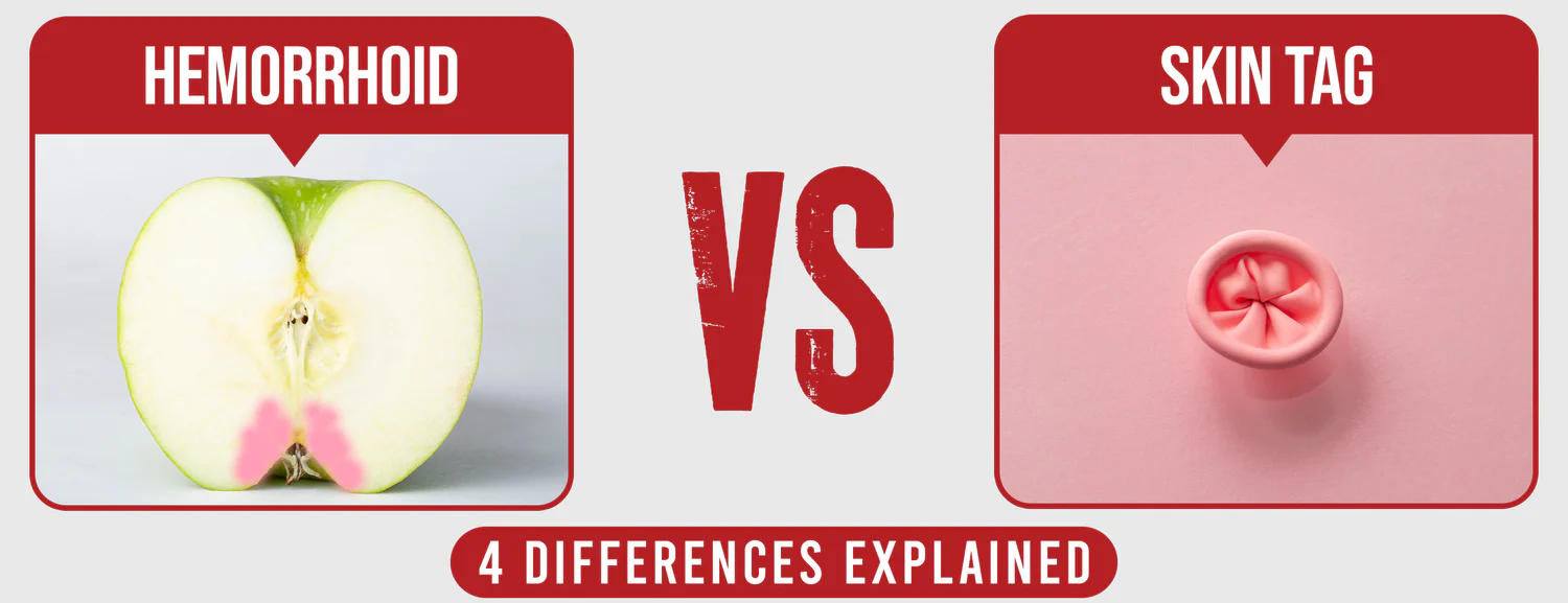 The 4 differences between a hemorrhage and a skin tag