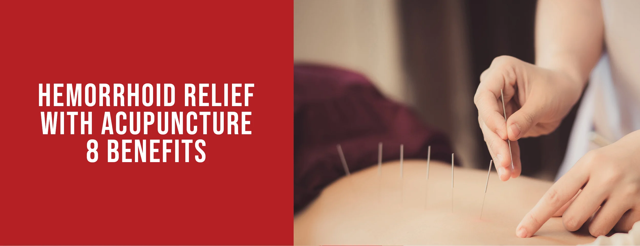 The 8 benefits of acupuncture for hemorrhoids