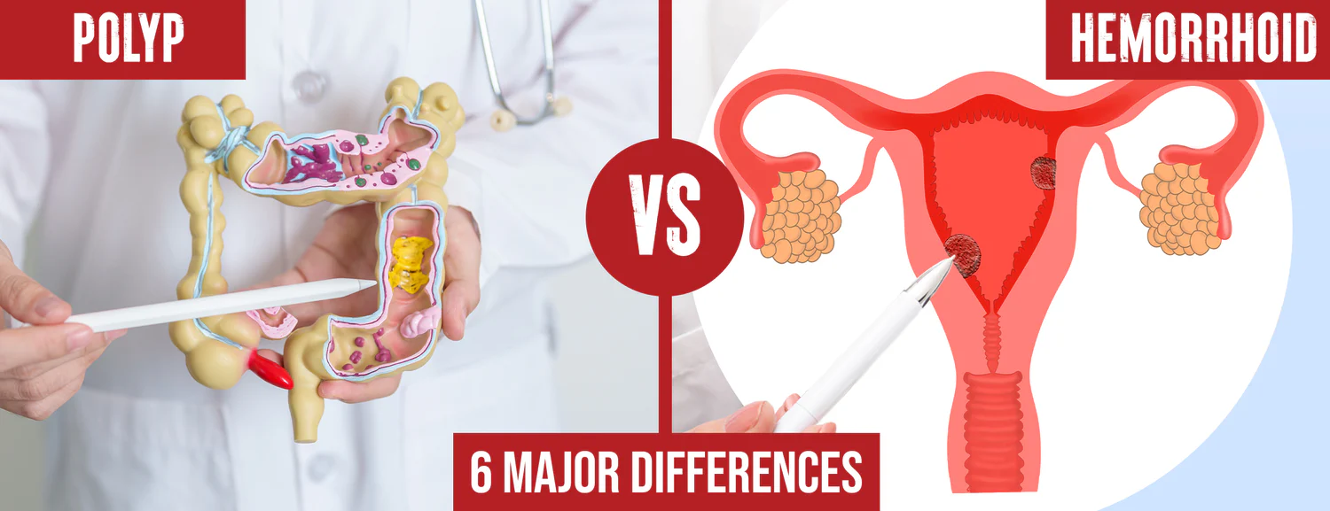 There are six major differences between polyps and hemorrhoids