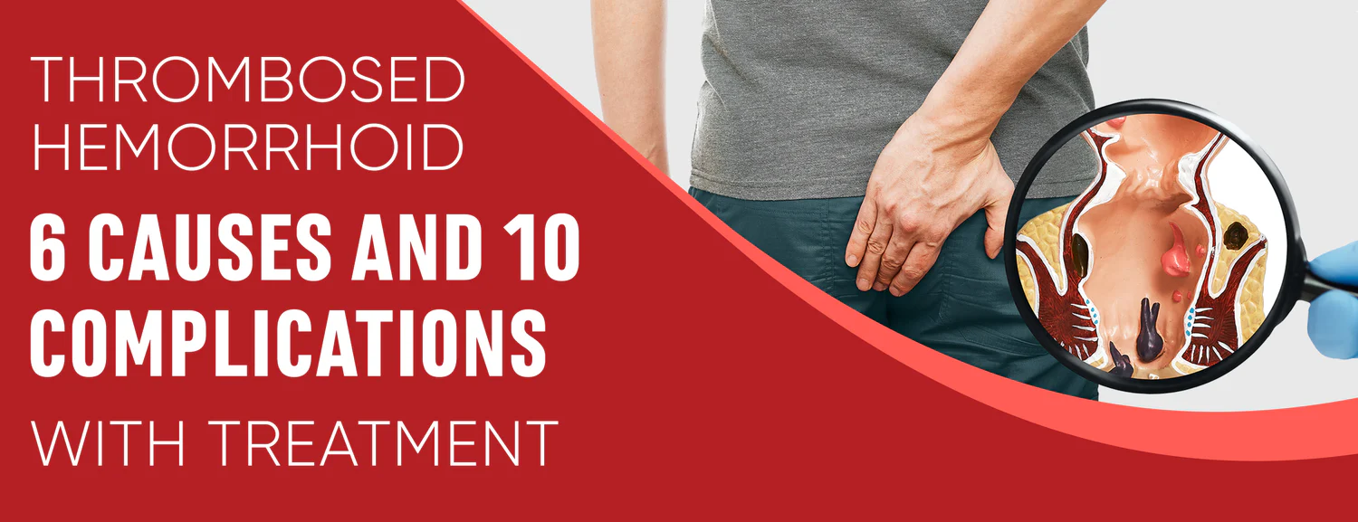 There are several causes of thrombosed hemorrhoids