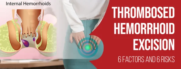 7 Factors and 6 Benefits of Thrombosed Hemorrhoid Excision