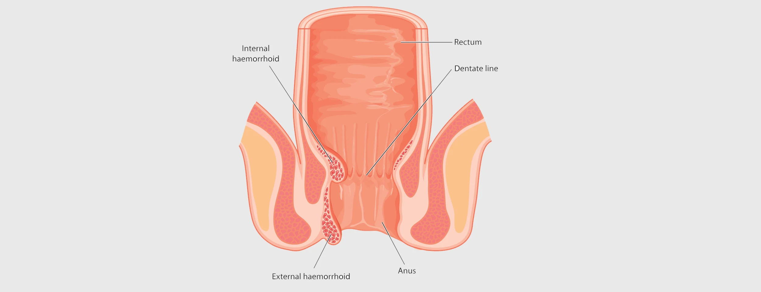 Here are 6 benefits of thrombosed hemorrhoids excision
