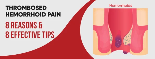 The 8 Causes & 7 Tips of Thrombosed Hemorrhoids