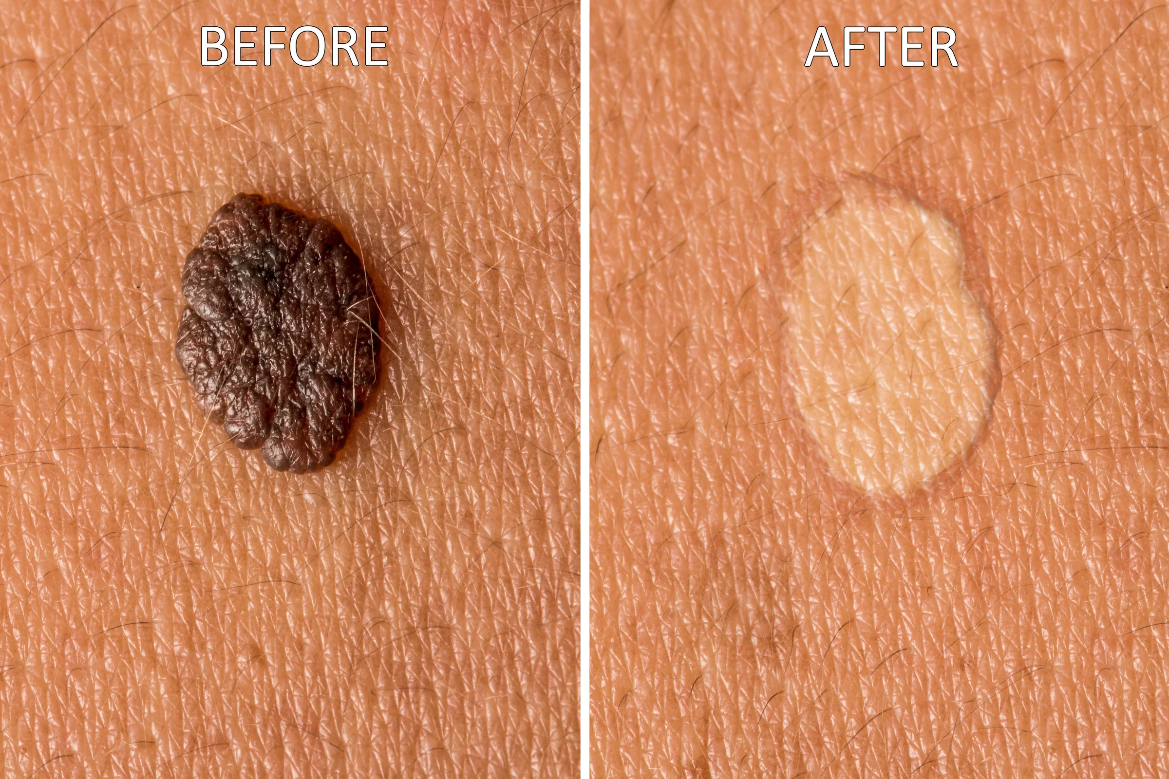 Treatment for skin tags Comprehensive Hemorrhoids and Skin Tag Management