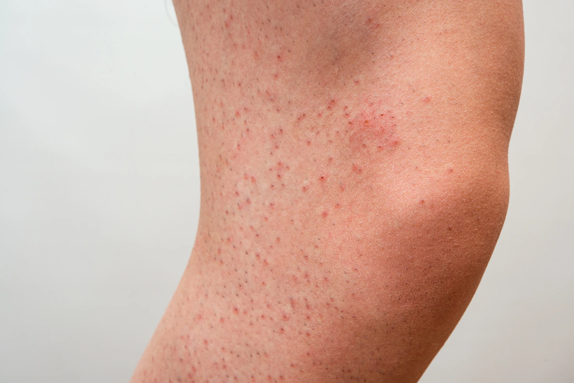 Why You Shouldn't Exfoliate Too Soon After Bikini Waxing