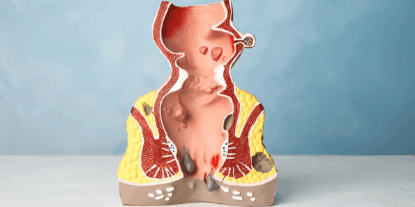 Differences Between a Hemorrhoid and a Fissure