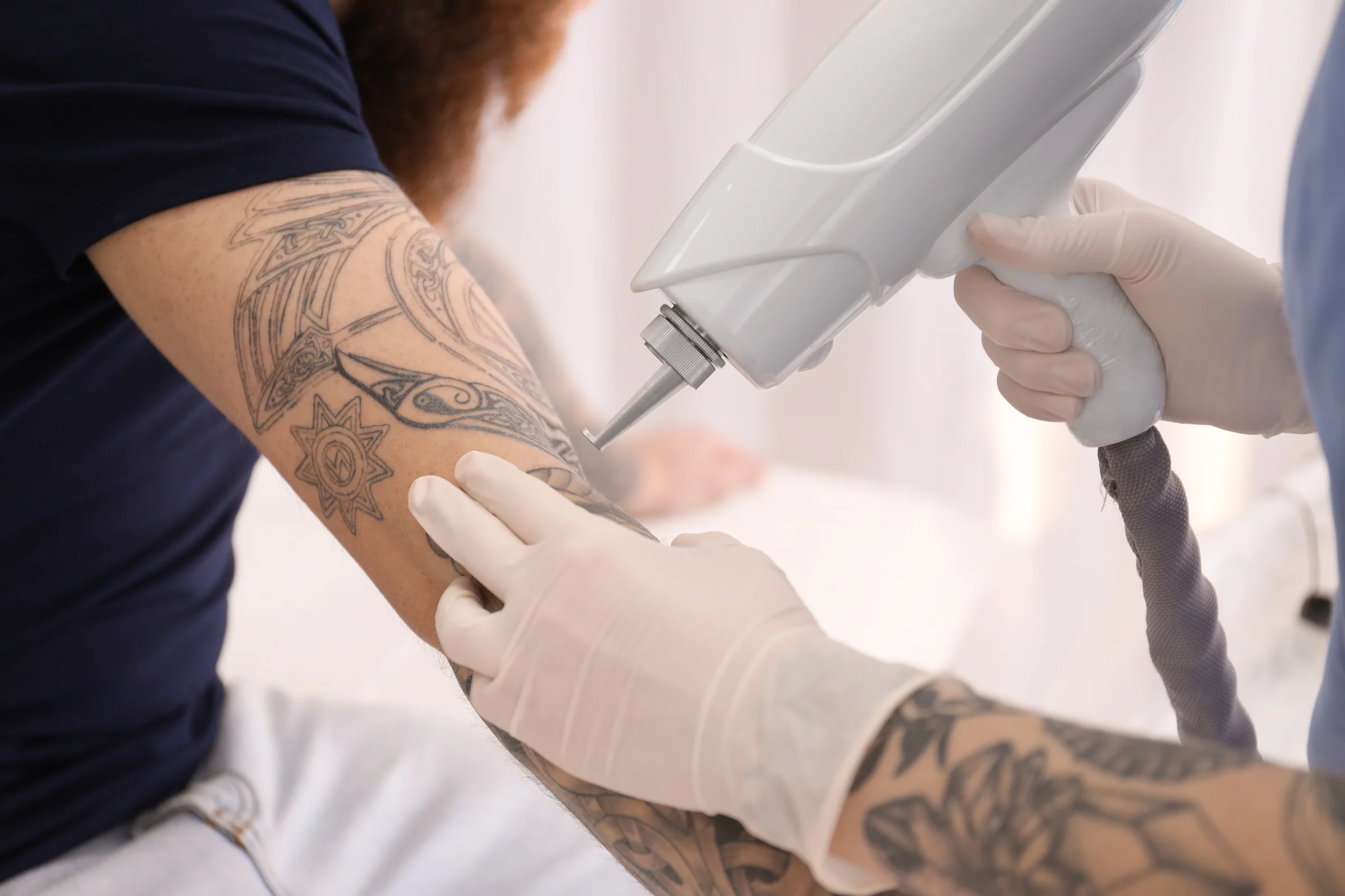 Mechanical and Chemical Methods to Remove Bad Tattoos at Home DIY