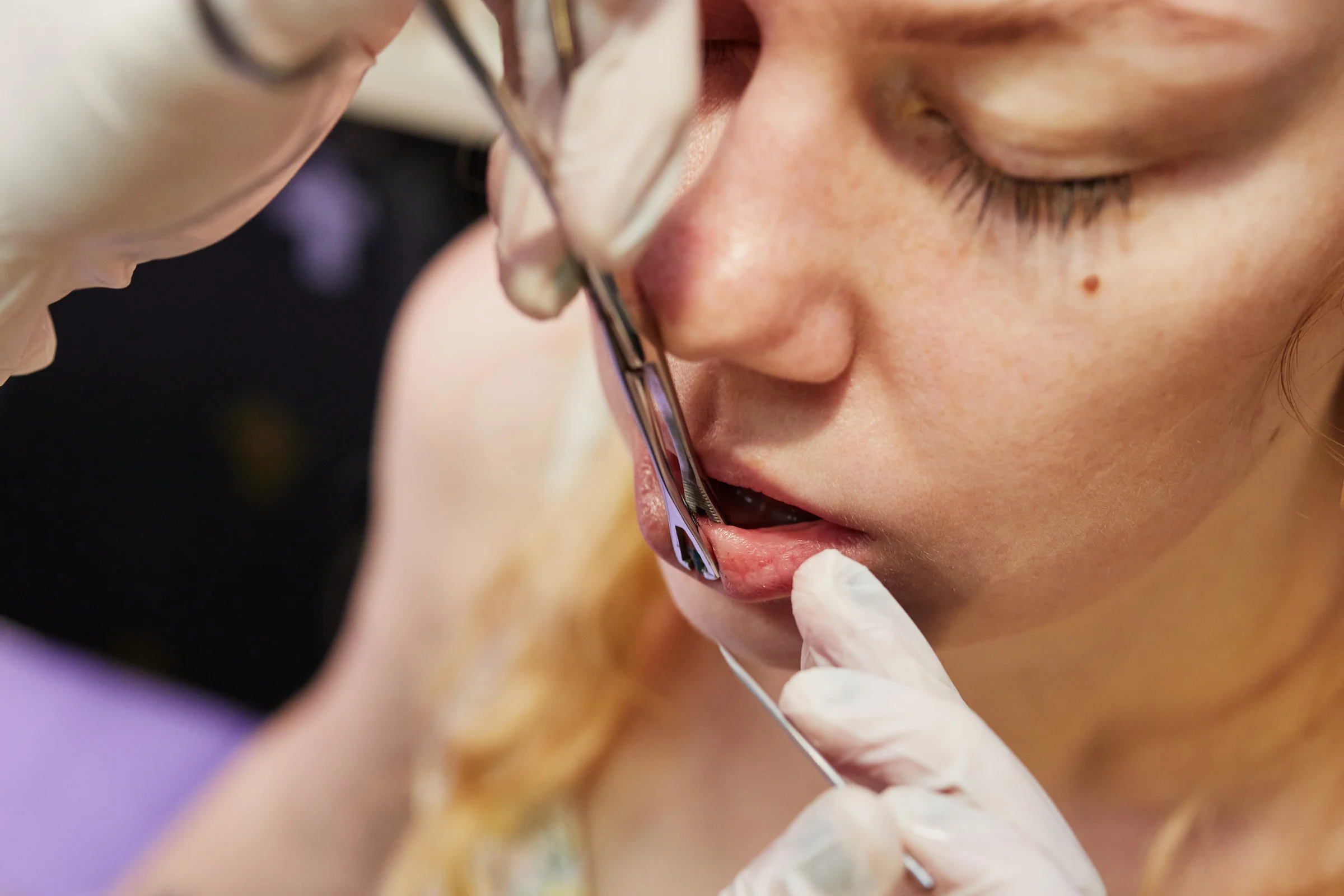 Preventive measures for lip piercing embedding