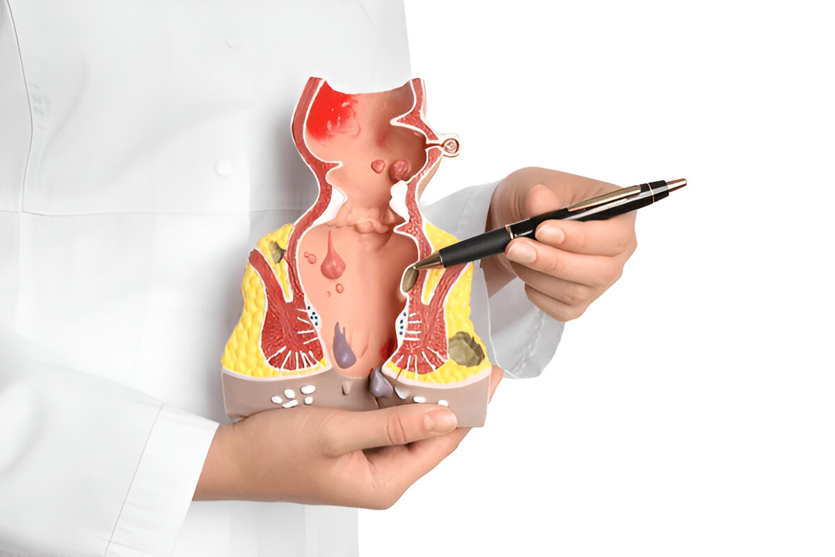 Six differences between hemorrhoids and fissures