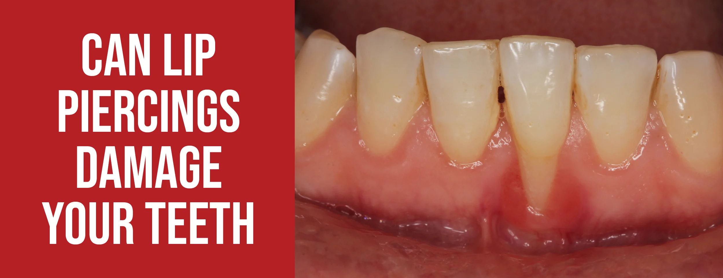 The Impact of Lip Piercings on Teeth