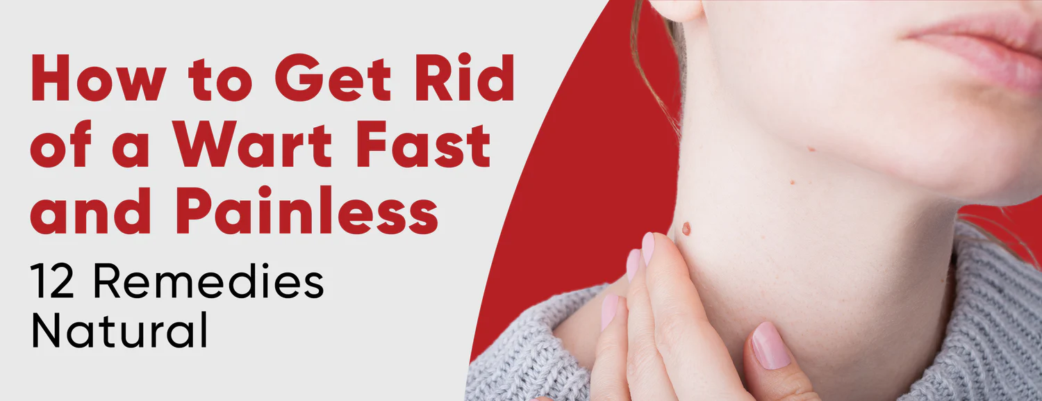 12 Natural Remedies for Warts & 7 Medical Treatments