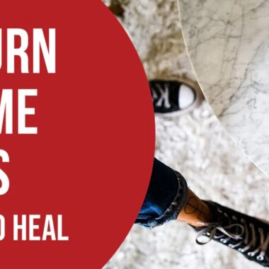 What To Do For Welding Burns on Skin | 8 Precautions